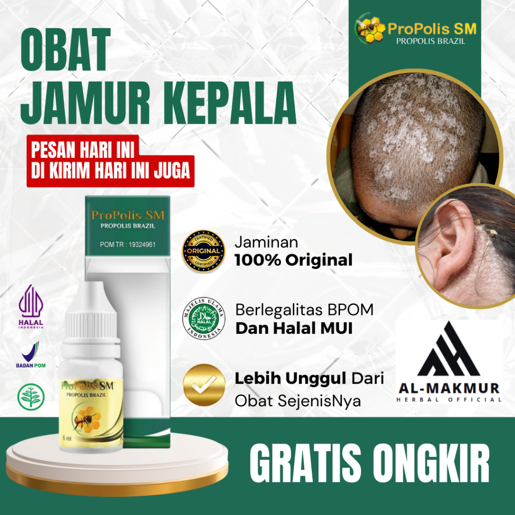 Obat Jamur Kepala, Obat Tinea Capitis, Pembasmi Jamur Kulit Kepala, Obat Ketombe, Obat Infeksi Jamur