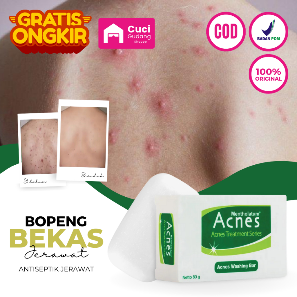 Sabun Acnes Pembersih Jerawat Punggung Dan Penghilang Bekas Jerawat Hitam Di Muka Dan Badan Pria Wan