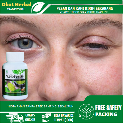 Obat Mata Ptosis, Obat Kelopak Mata Kendur, Obat Kelopak Mata Turun Sebelah, Mata Sipit Sebelah, Oba