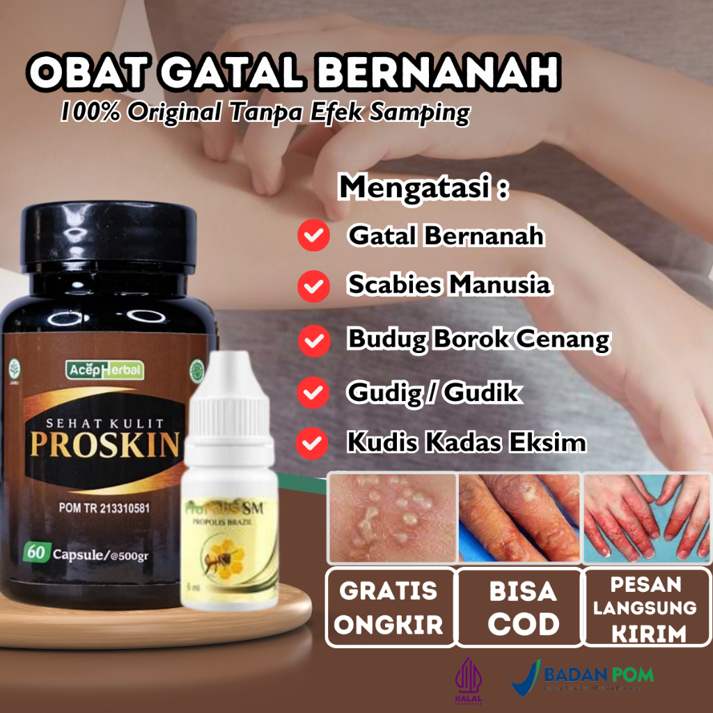 Obat Budug Bernanah, Obat Scabies Manusia, Obat Cenang Bernanah, Penghilang Korengan di kaki, Obat S