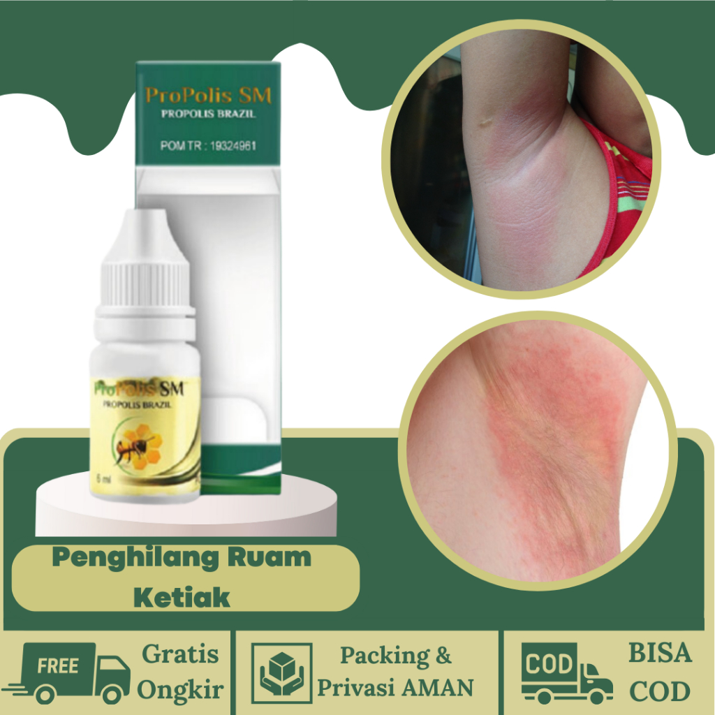 Obat Penghilang Ruam Gatal Di Ketiak,  Gatel Merah Pada Ketiak, Psoriasis, Dermatitis, Obat Ketiak G