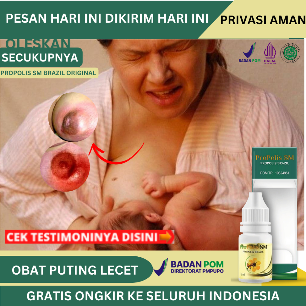 Obat Puting Lecet, Obat Puting Susu Lecet Menyusui, Obat Puting Luka Karena Gigitan Bayi, Obat Putin