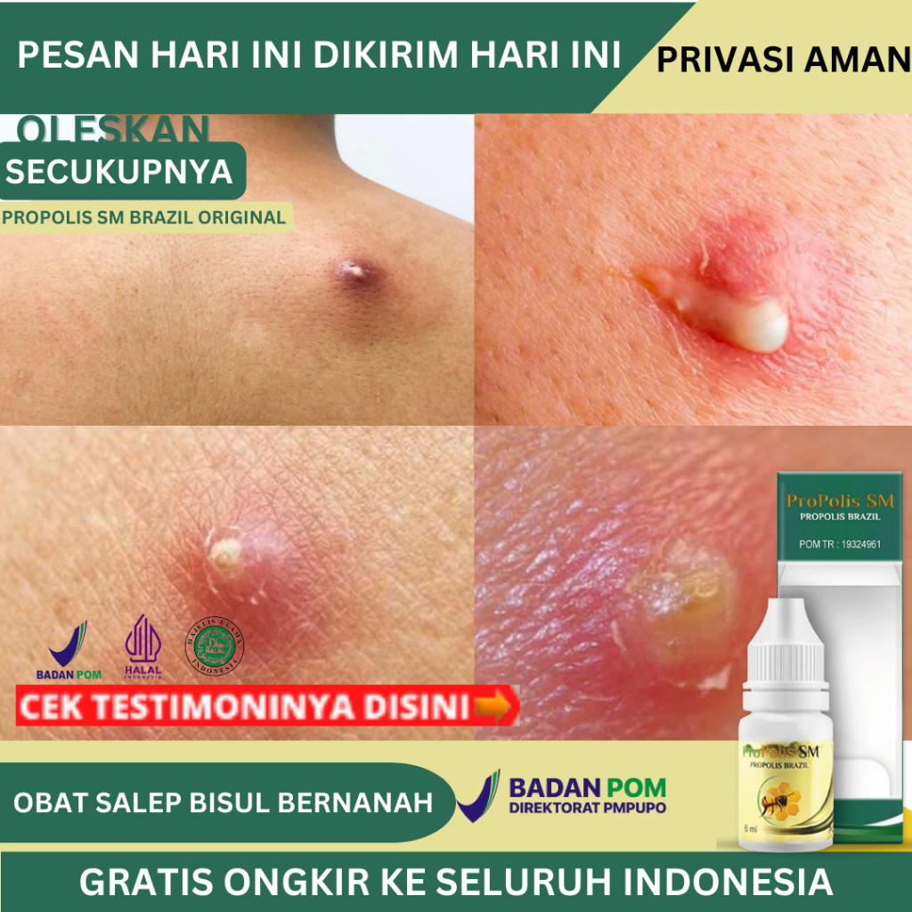 Obat Bisul, Obat Penghilang Bisul, Obat Bisul Bernanah, Obat Bisul Salep, Obat Bisul Di Kepala Bayi 