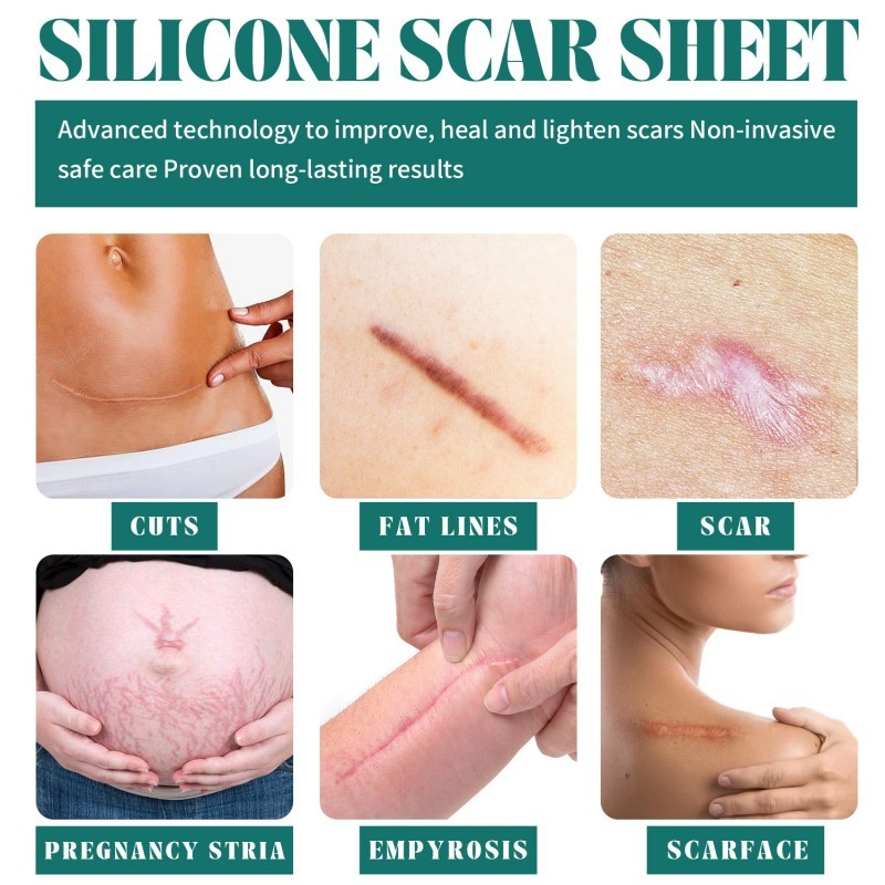 Silicone Scar Sheet 4cm x 1.5m plester Scar Removal Silicone Tape Penghilang bekas luka keloid penghilang strechmark