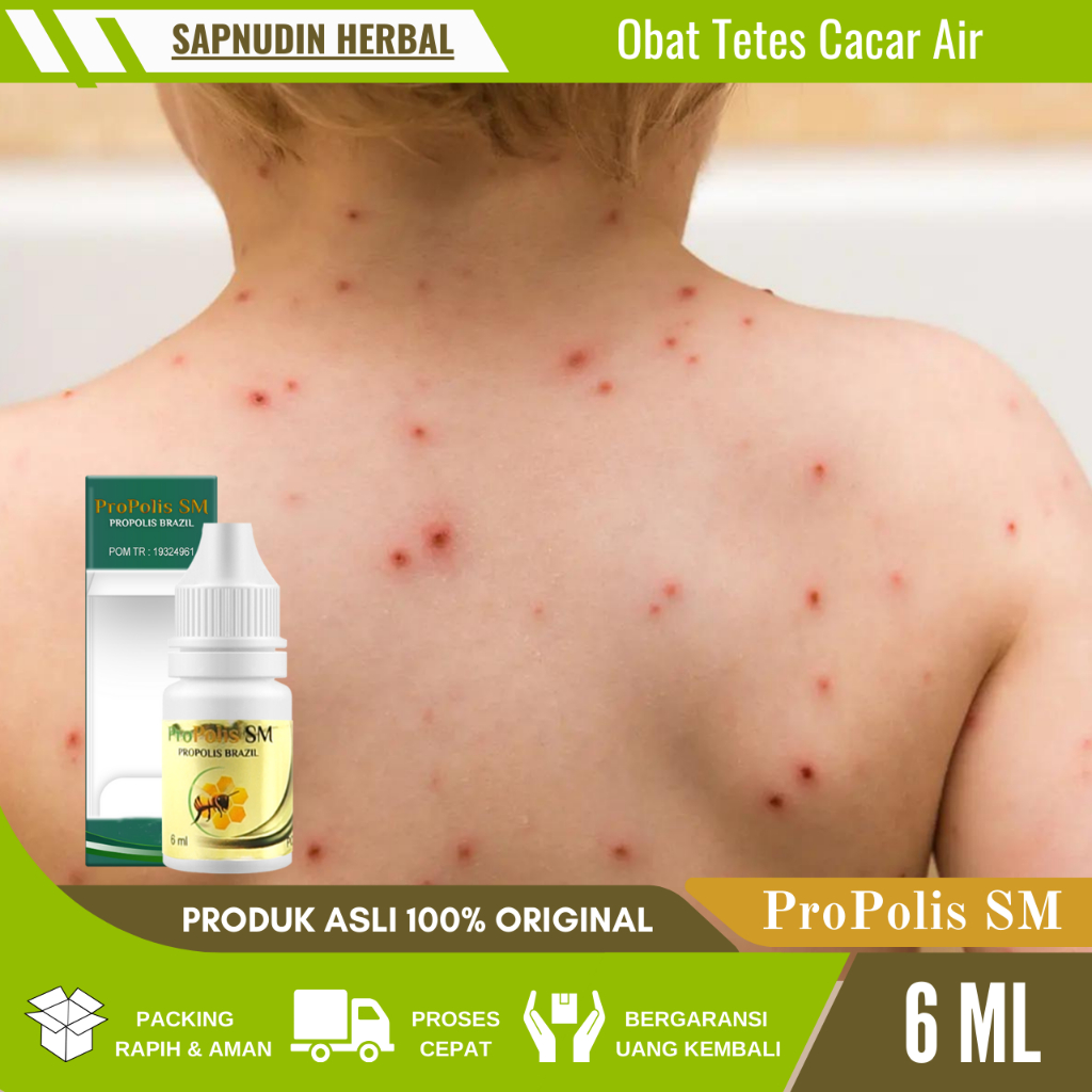 Obat Cacar Air Paling Laris, Obat Cacar Air, Obat Cacar Air Di Apotek, Obat Cacar Air Anak, Obat Cac