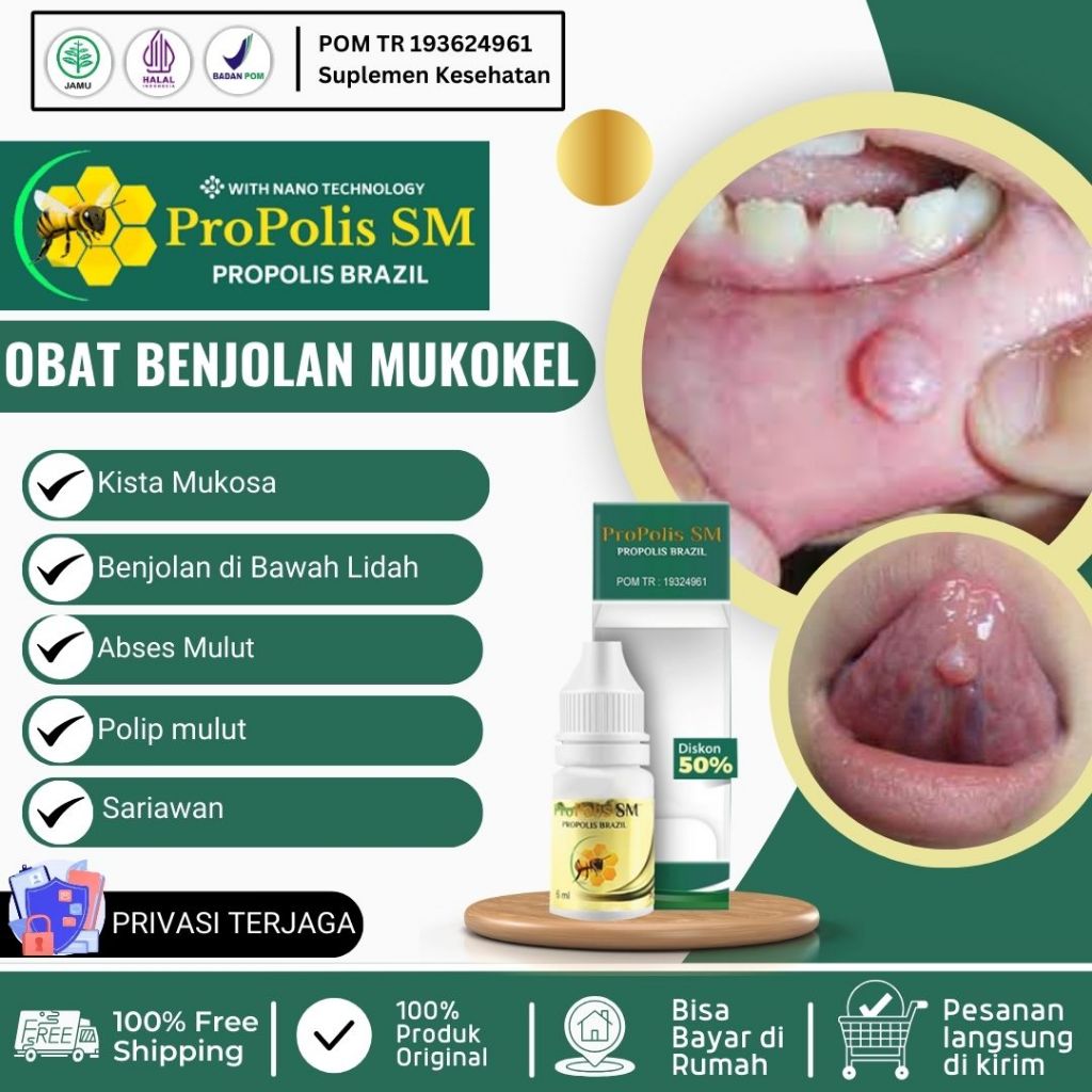 Obat Mukokel, Obat Penghilang Benjolan Mucocele, Penghilang Benjolan di Bawah Lidah, Obat Benjolan M