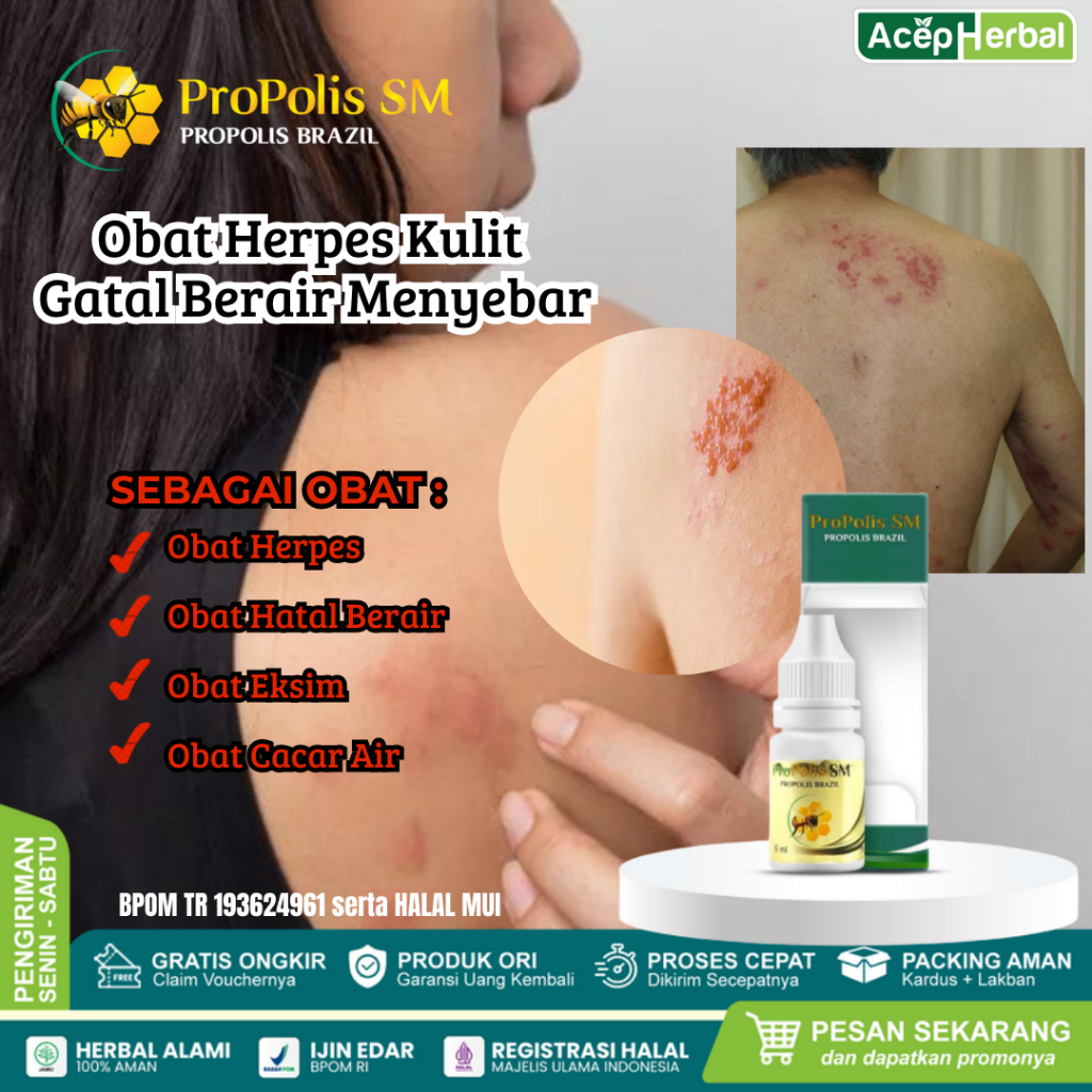 Propolis SM - Obat Oles Herpes, Herpes Zoster, Herpes Kelamin, Herpes Genital, Herpes di Bibir