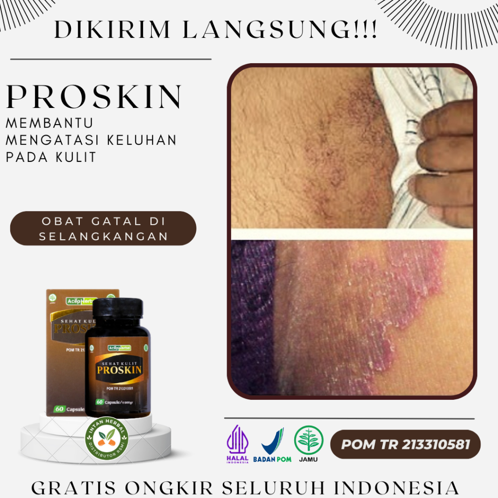 Proskin 100% Original - Obat Gatal Di Selangkangan, Jamur Selangkangan, Iritasi Kulit Selangkangan, 
