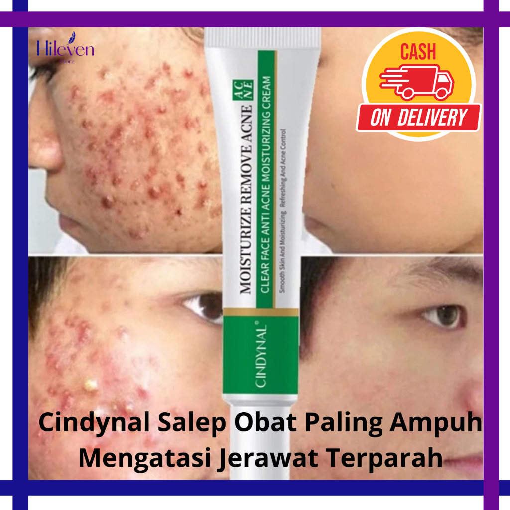 Cindynal Salep Obat Paling Ampuh Mengatasi Jerawat Terparah Pembersih Jerawat
