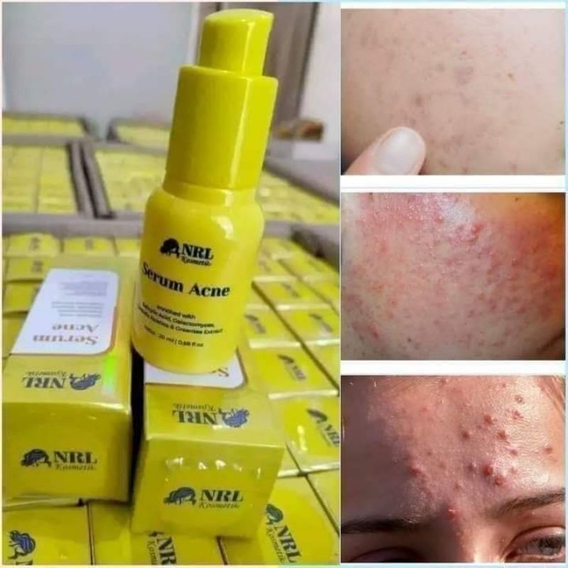 Serum acne nrl