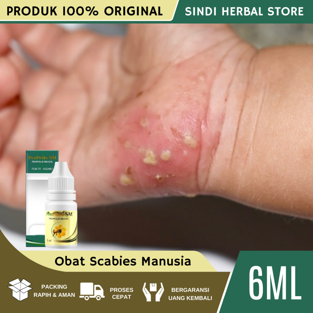 Obat Gatal Scabies Manusia, Obat Scabies Manusia, Obat Gatal Scabies Alami, Obat Gatal Scabies, Sale