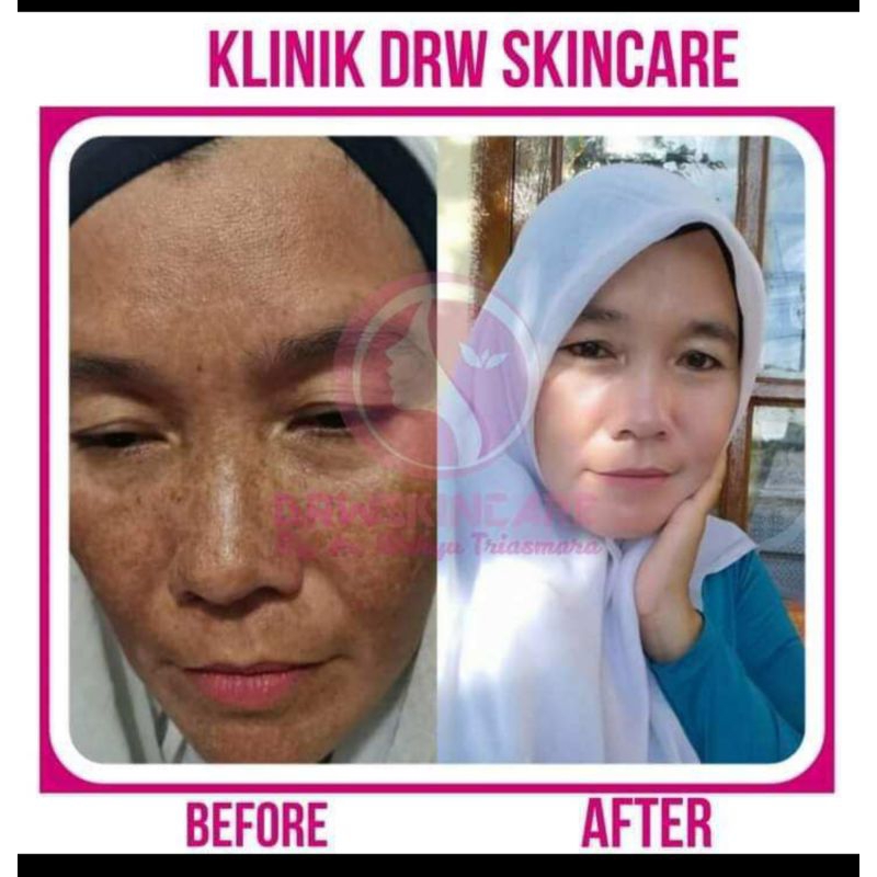 paket hemat khusus untuk flek drw skincare, untuk flek ringan dan flek membandel radiant brightening