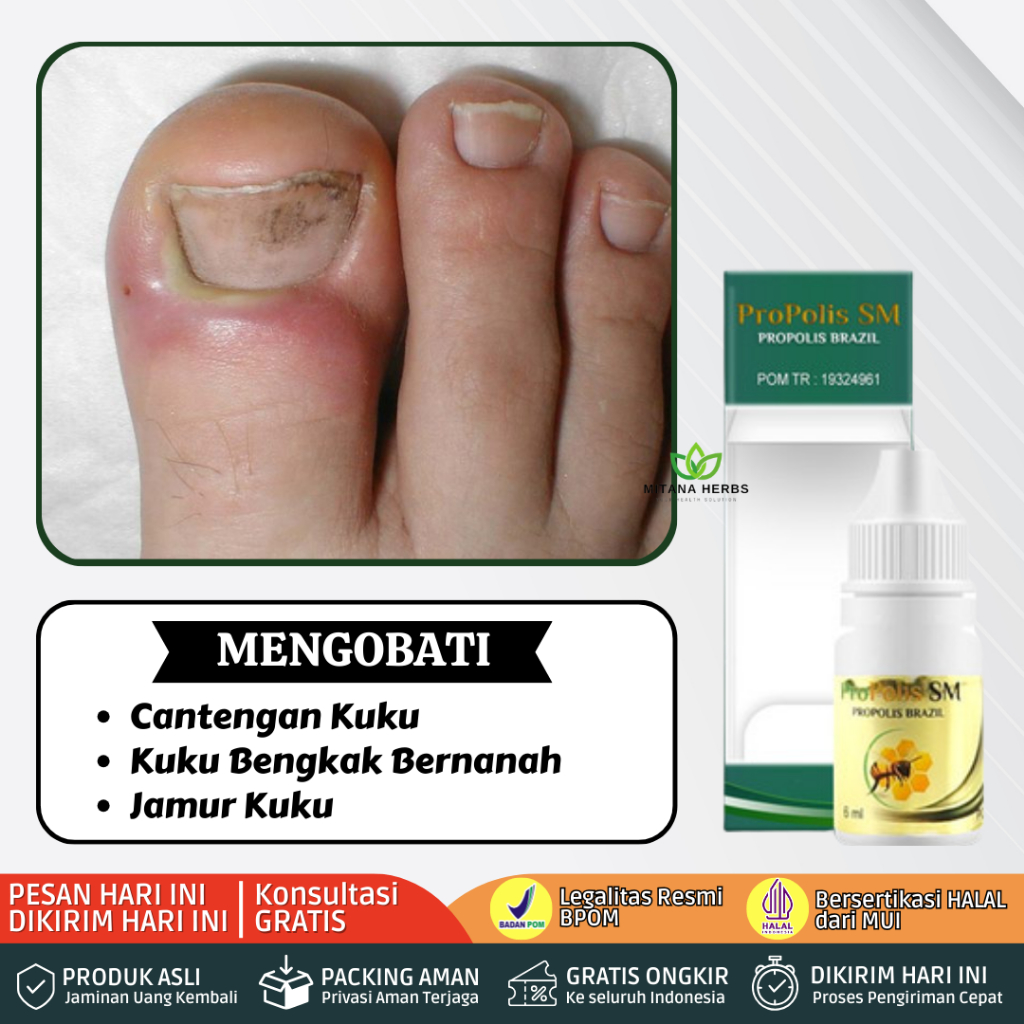 Obat Cantengan Kuku, Obat Cantengan Jempol Kaki, Obat Cantengan Kaki Bengkak Bernanah Nyeri Kuku Jam