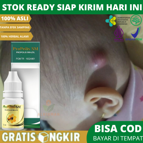 Obat Bisul Bernanah, Bisul Di Kepala Bayi / Anak / Dewasa, Obat Benjolan Di Kepala, Obat Bisul Tidak