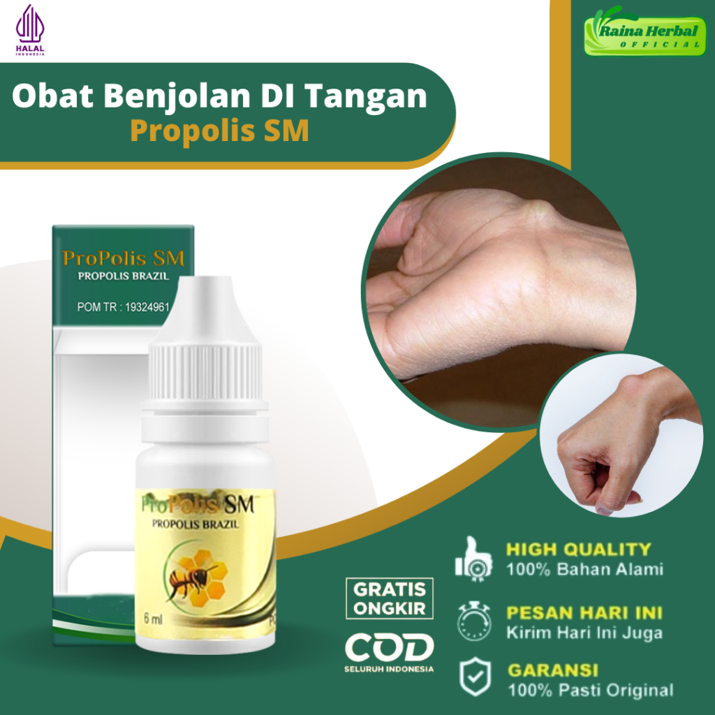 Obat Benjolan di Tangan Kista Ganglion Penghilang Benjolan Di Pergelangan Tangan Pengempis Benjolan 