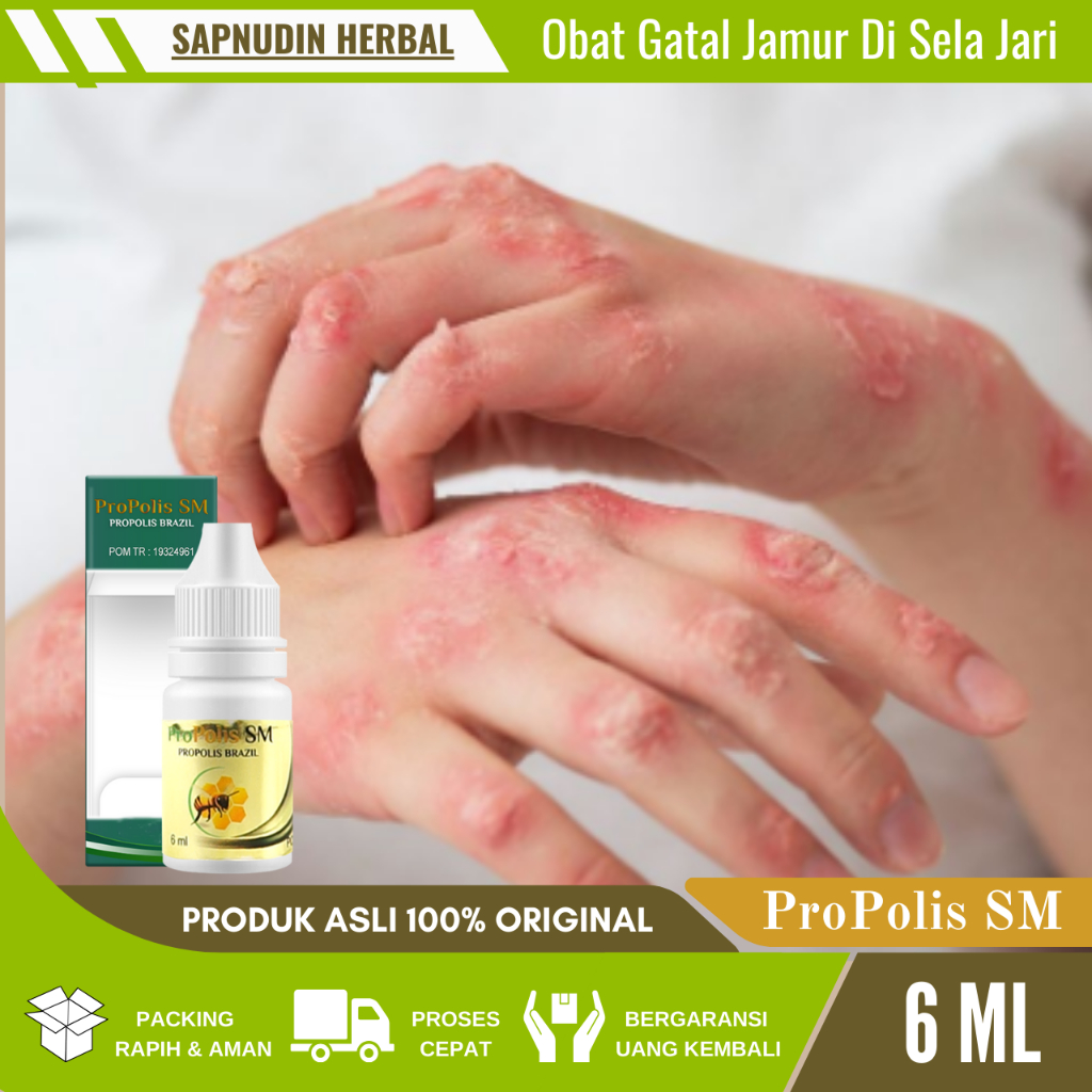 Obat Gatal Jamur Di Sela Jari, Obat Gatal Berair, Obat Gatal Pantat, Obat Jamur Pantat, Obat Bruntus