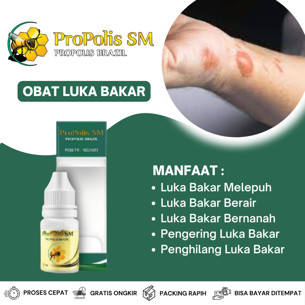 Obat Luka Bakar Melepuh, Obat Luka Bakar Bernanah, Obat Luka Bakar Berair, Obat Luka Bakar Parah, Ob