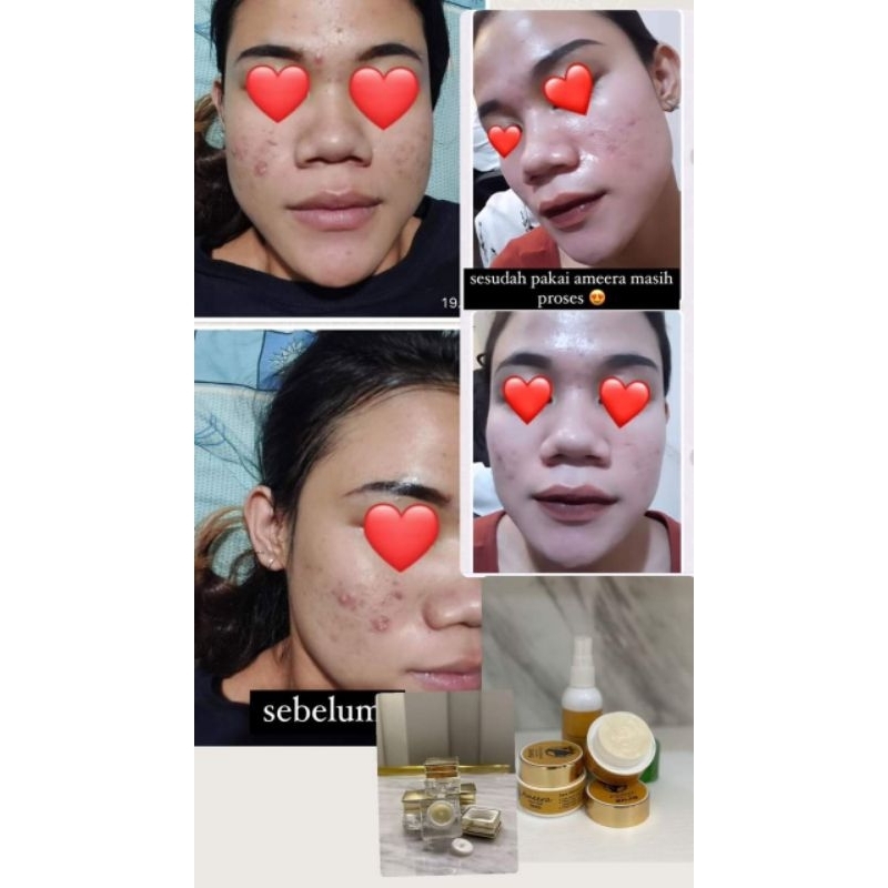 PAKET LENGKAP SKINCARE AMEERA BEAUTY SKIN