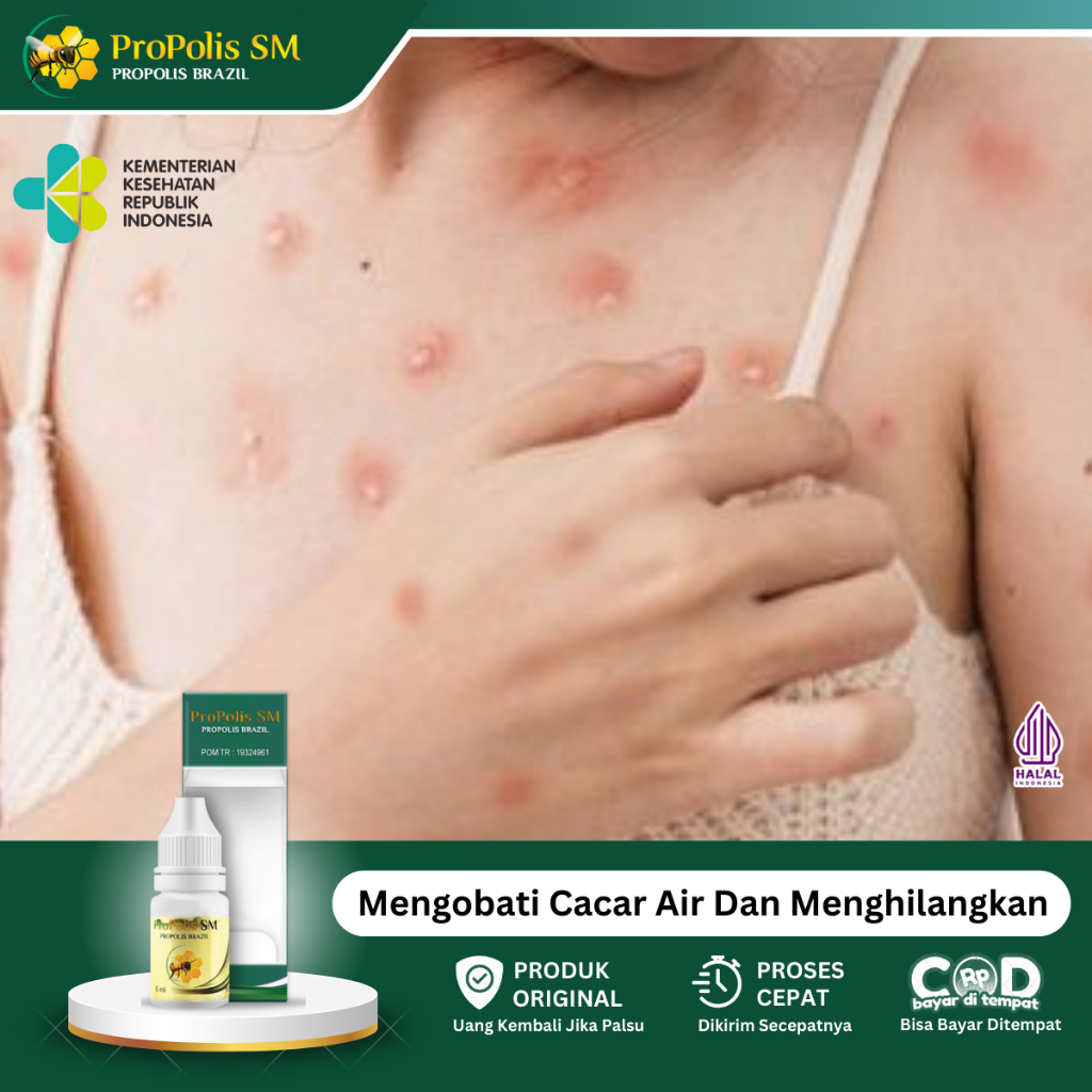 Obat Cacar Air, Obat Gatal Berair, Obat Kulit Cenang Bernanah, Obat Cacar Api, Obat Penghilang Bekas