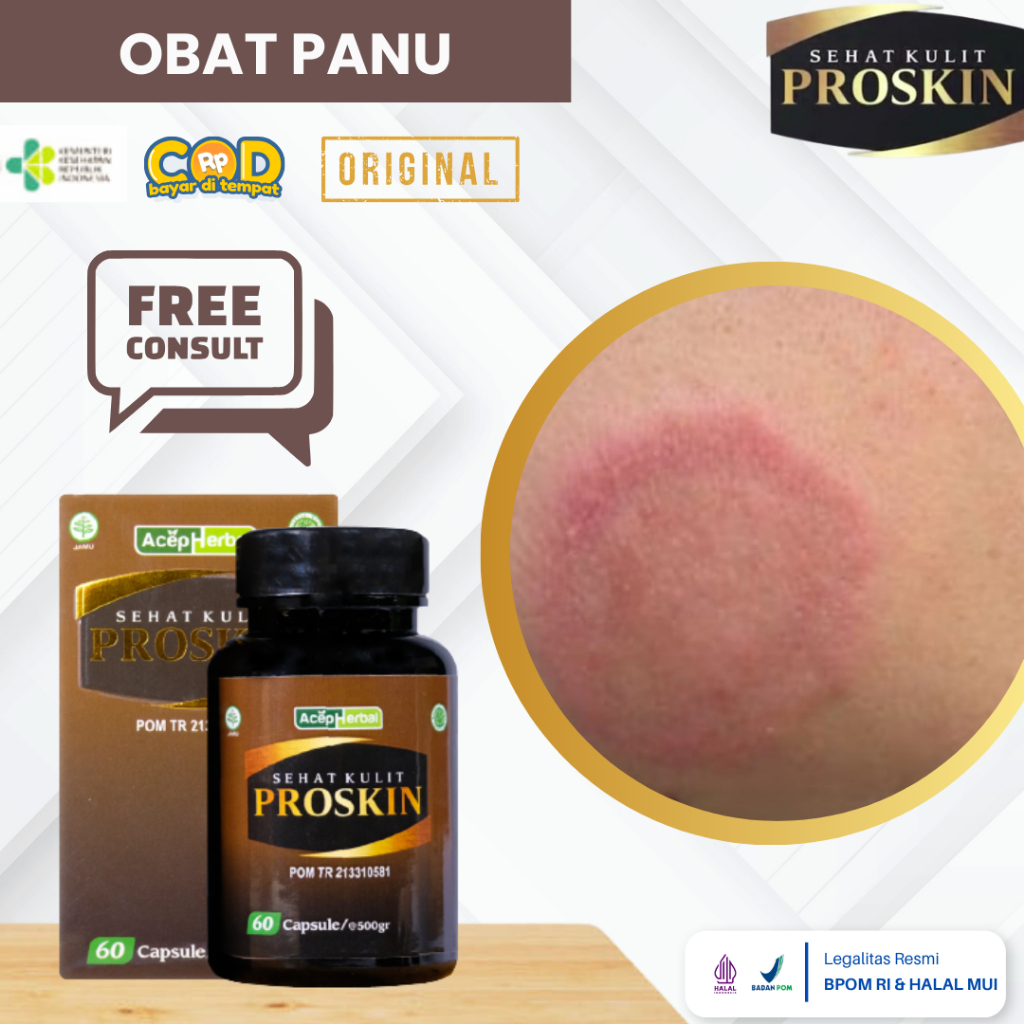 Obat Panu Menahun, Obat Kulit Gatal Gatal, Obat Gatal Jamur Kulit, Obat Bercak Putih Di Wajah, Infek