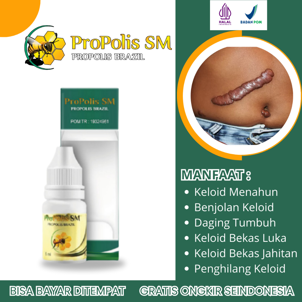 Obat Keloid Menahun, Obat Keloid Menonjol, Obat Keloid Daging Tumbuh, Obat Keloid Bekas Jahitan, Oba