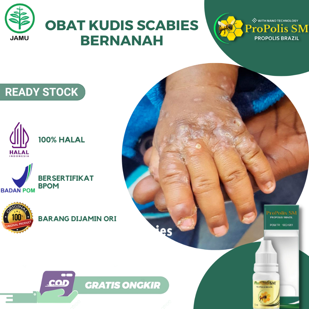 Obat Kudis Scabies Manusia Obat Kudis Anak Gatal Bernanah Cenang Bernanah Anak Budug Bernanah di Tan