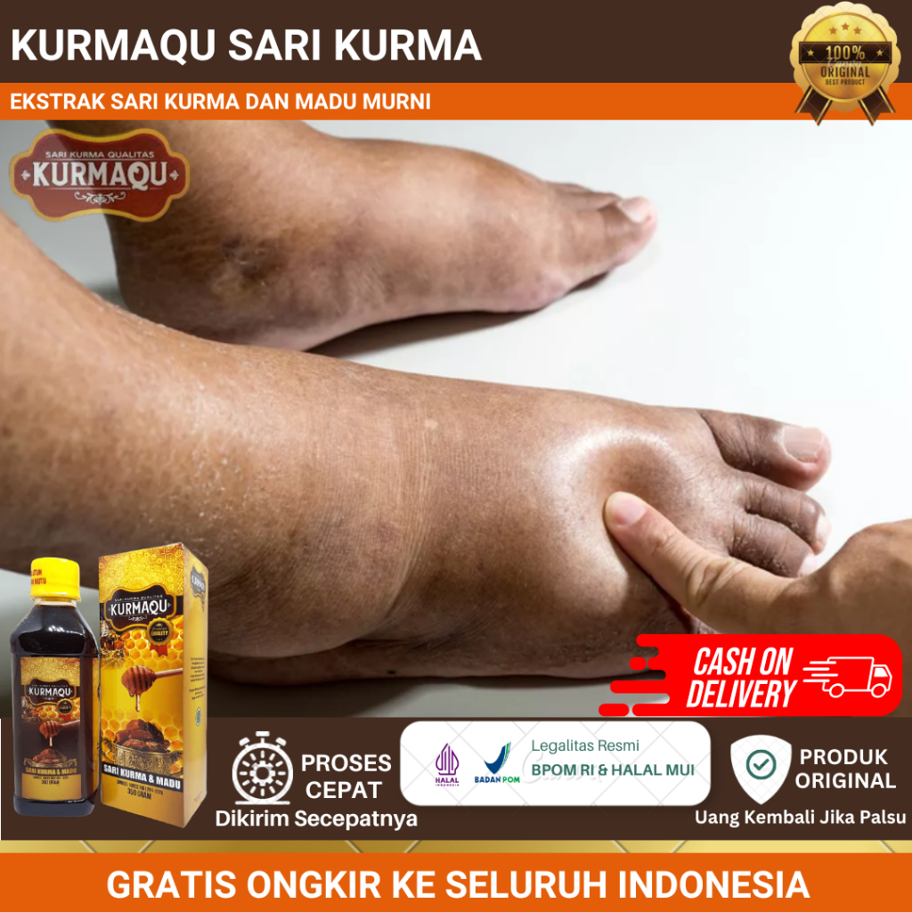 Kurmaqu - Obat Bengkak Pada Kaki, Kaki Bengkak Karena Asam Urat, Diabetes, Jantung, Dan Ginjal, Jemp