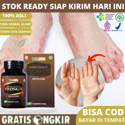 Obat Gatal Berair di Jari Tangan dan Jari Kaki, Obat Gatal Bintik Berair, Obat Gatal Kutu Air Parah 