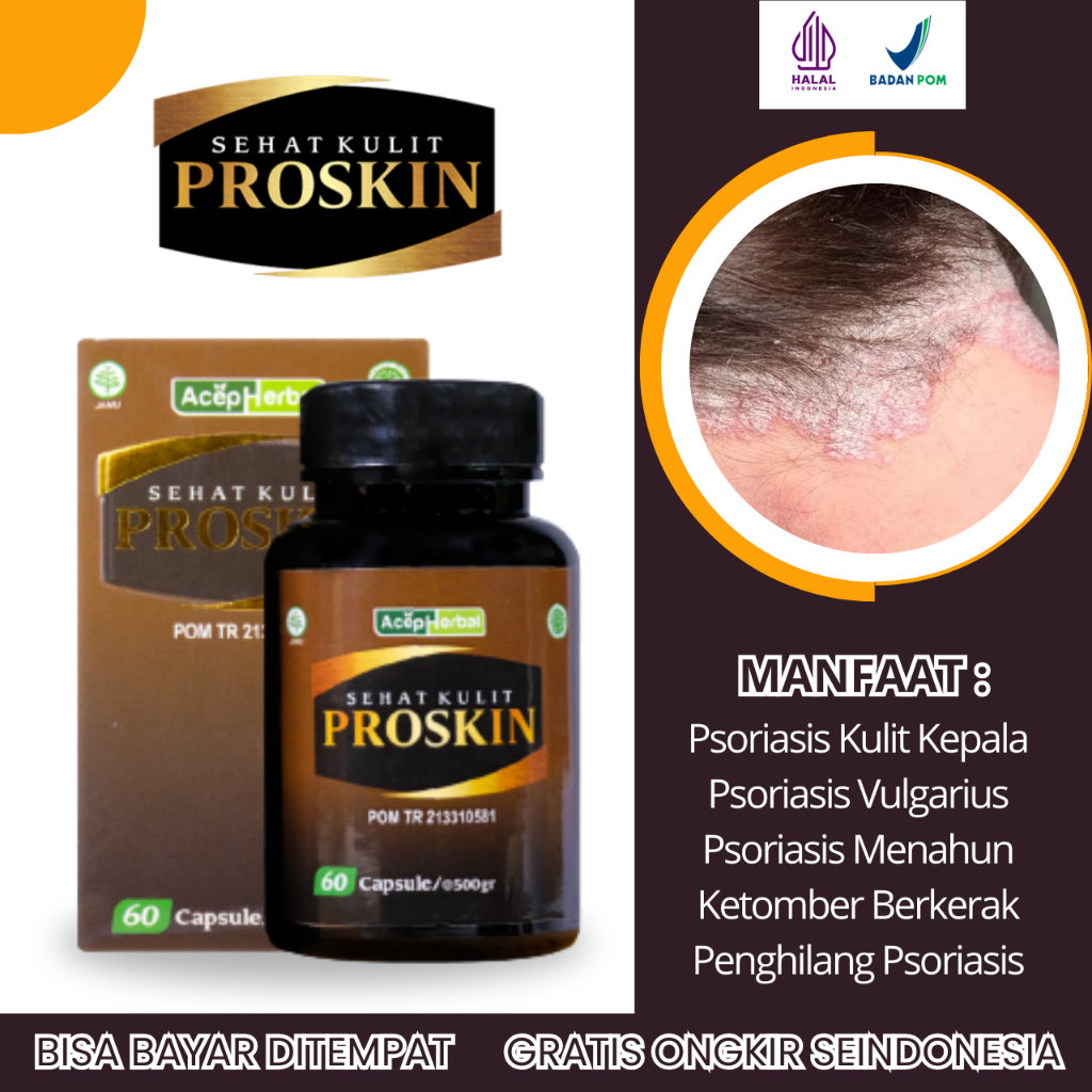 Obat Psoriasis Kulit Kepala, Obat Psoriasis Vulgaris, Obat Psoriasis Menahun, Obat Kulit Bersisik, O