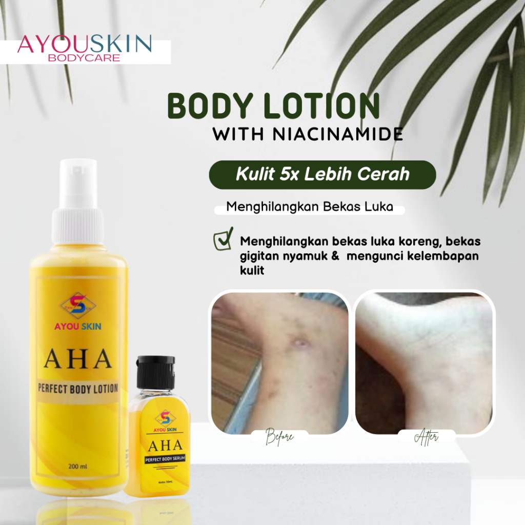 Cream Krim Body Lotion Menghilangkan Penghilang Bekas Luka Koreng Menghitam di Kaki Tangan, Losion P