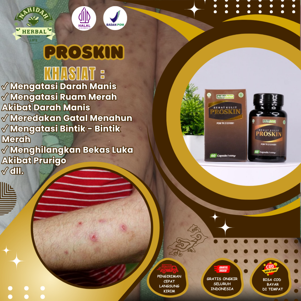 Obat Darah Manis, Obat Ruam Merah Akibat Darah Manis, Obat Prurigo, Gatal Menahun, Bintik - Bintik M