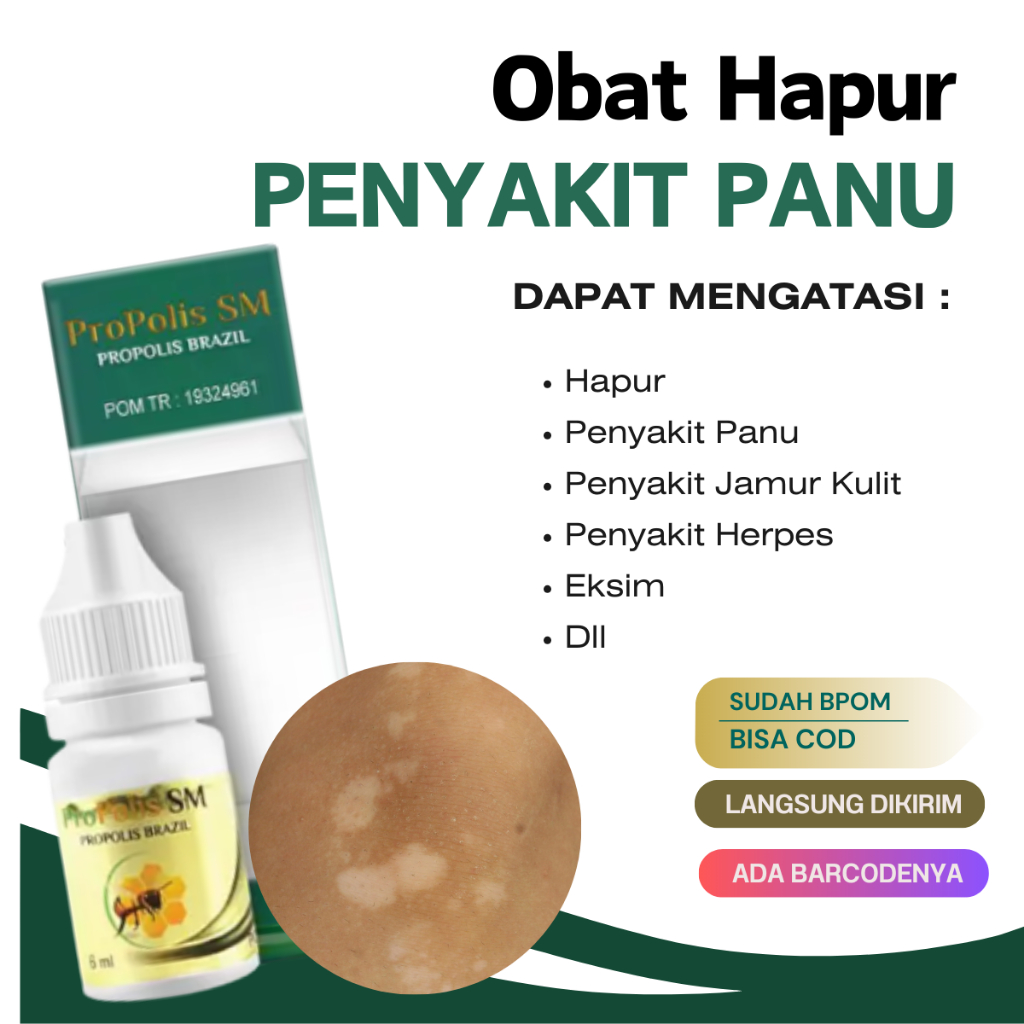 Obat Hapur Kulit Propolis SM Brazil 100% Original - Obat Panu - Obat Bintik Putih Di Kulit