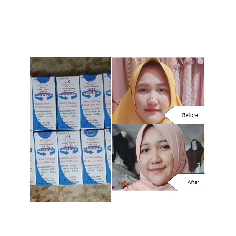 cream penghilang tahi lalat original