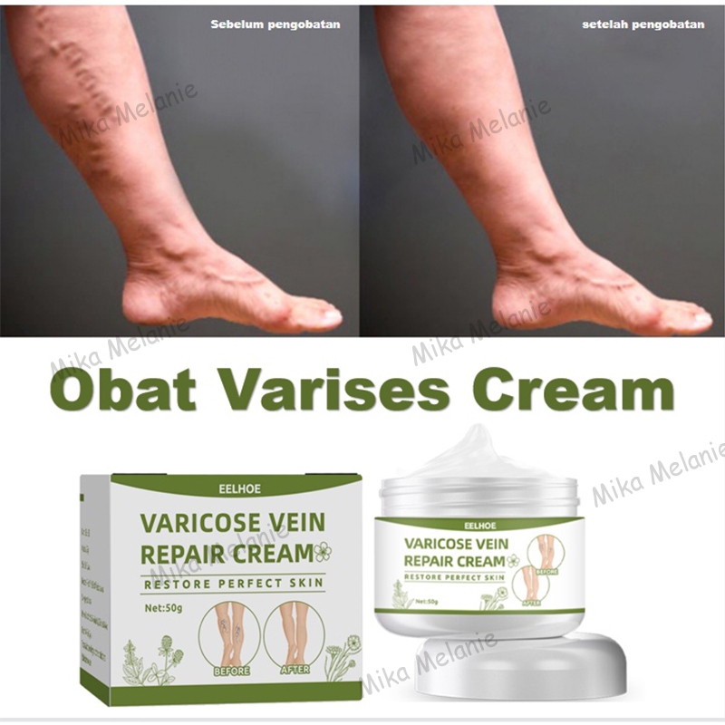 Bekas Penghilang Varises Cream Obat Varises Salep Penghilang Varicose Vein Treatment Cream 50g Spide
