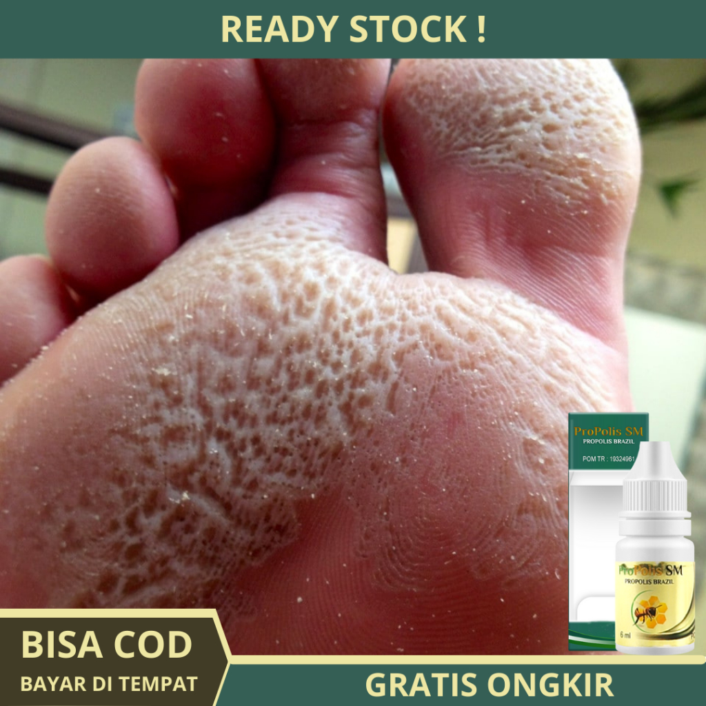 Obat Kaki Pecah dan Kering Obat Kaki Rayapan dan Bau Obat Penghalus Tumit Obat Penghilang Kapalan Ma