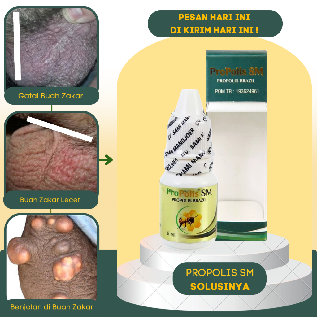 Obat Buah Zakar Gatal, Obat Buah Zakar Bentol Bintik Bintik, Obat Gatal di Buah Zakar Pria, Obat Kut