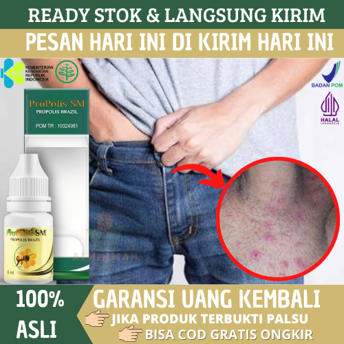 Obat Gatal Gatal Kelamin, Obat Penis Gatal,  Penis Lecet, Penis Infeksi, Obat Herpes Kelamin, Gatal 