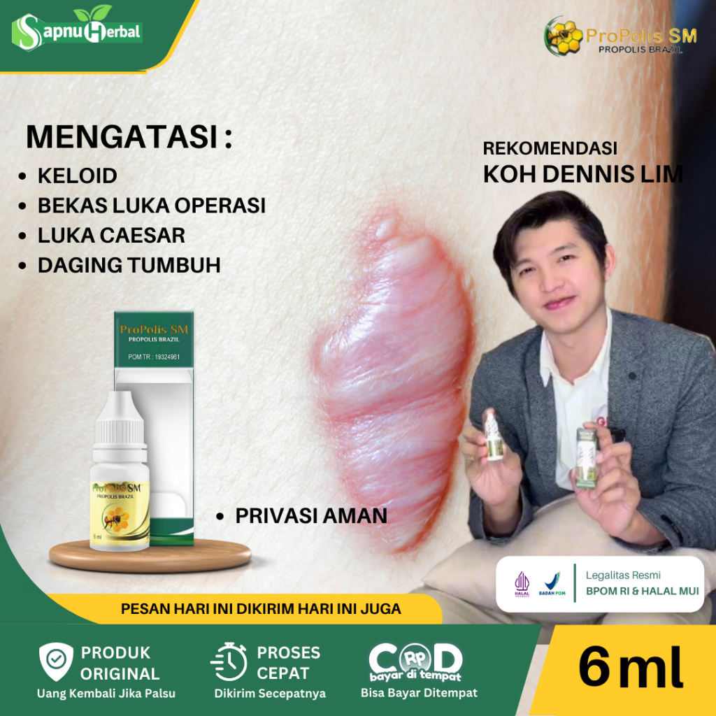 Propolis Sm Obat Keloid, Obat Keloid Di Telinga, Obat Keloid Menonjol Tahunan, Obat Keloid Daging Tu