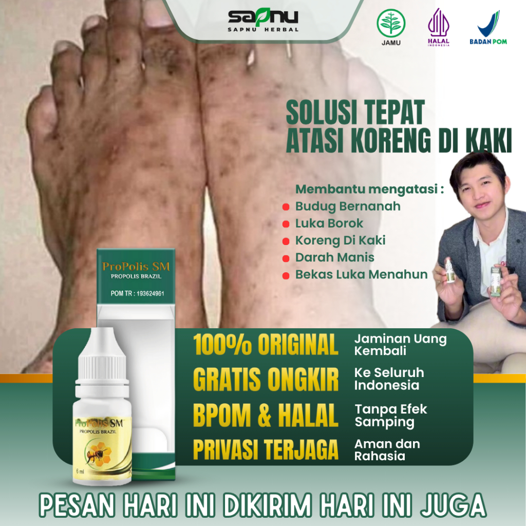 Propolis SM Obat Penghilang Bekas Koreng Di Kaki, Obat Koreng Bernanah Di Kaki Koreng Di Kaki, Obat 