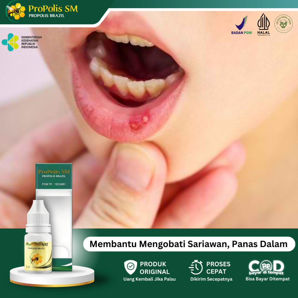 Obat Sariawan Di Bibir, Bibir Pecah Pecah, Bau Mulut Tak Sedap, Sariawan Mulut Anak Dewasa, Panas Da