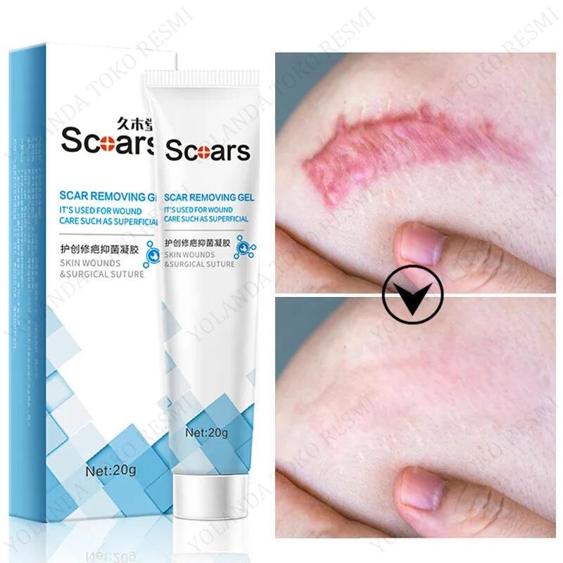 [ORI ]Obat Penghilang Bekas Luka Lama Hitam Koreng Bakar Knalpot Jerawat Operasi Scar Keloid Selulit Strech Stretch Mark Dermatik Salep Gel Cream Krim Oil Serum Removal Perawatan Diri Wajah Tubuh Ampuh