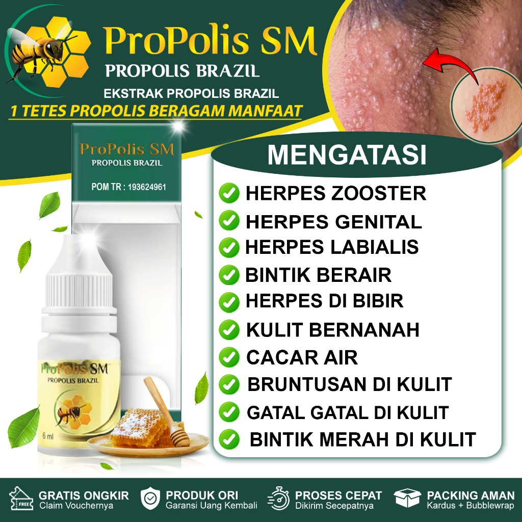 Obat Herpes Zooster Herpes Labialis Herpes Genital Herpes Bibir Kulit Cacar Bintik Berair - Propolis