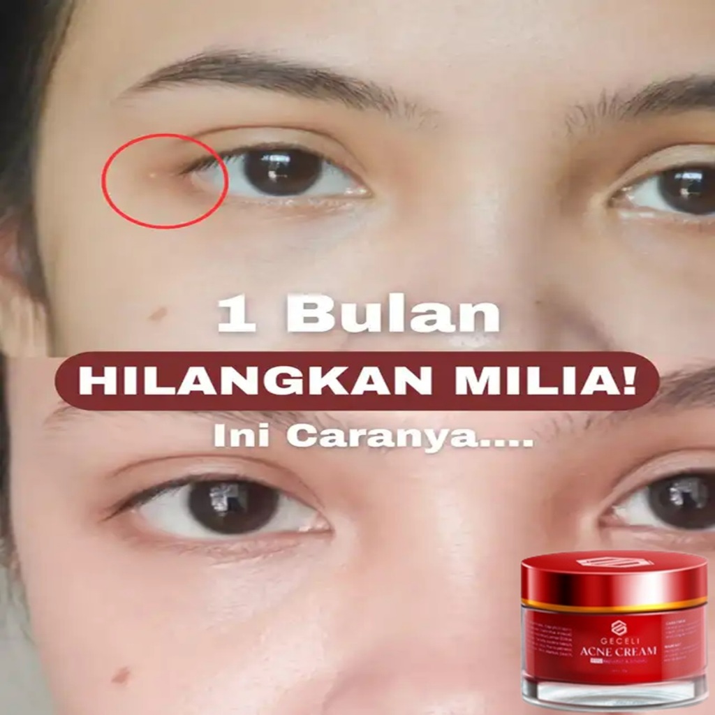 cream acne milia khusus milia aha bha cream bruntusan cream glowing
