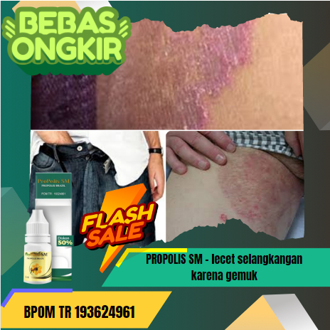 PROPOLIS SM - lecet selangkangan karena gemuk, Penghilang selangkangan lecet karena celana, obat sel
