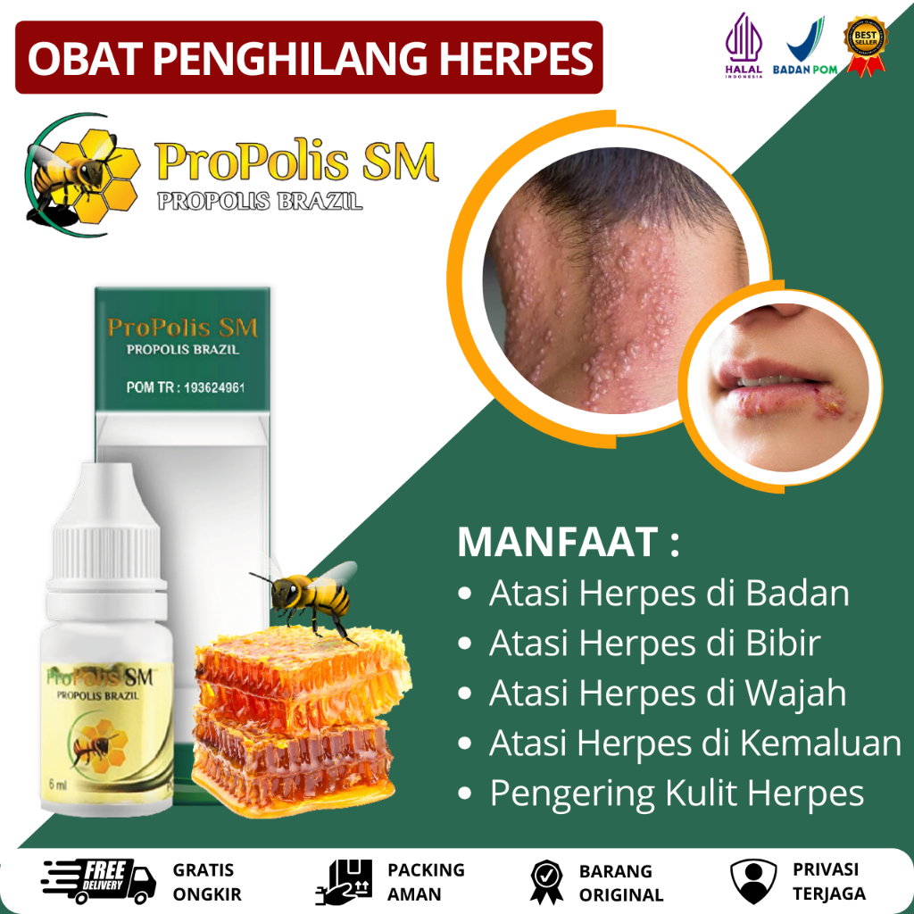 Obat Herpes di Kulit, Obat Herpes Genital, Obat Herpes Zoster, Obat Herpes di Bibir, Obat Herpes di 