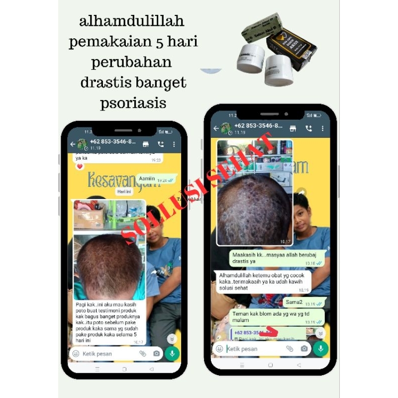 Paket Betamic obat psoriasis,ketombe parah dan obat gatal