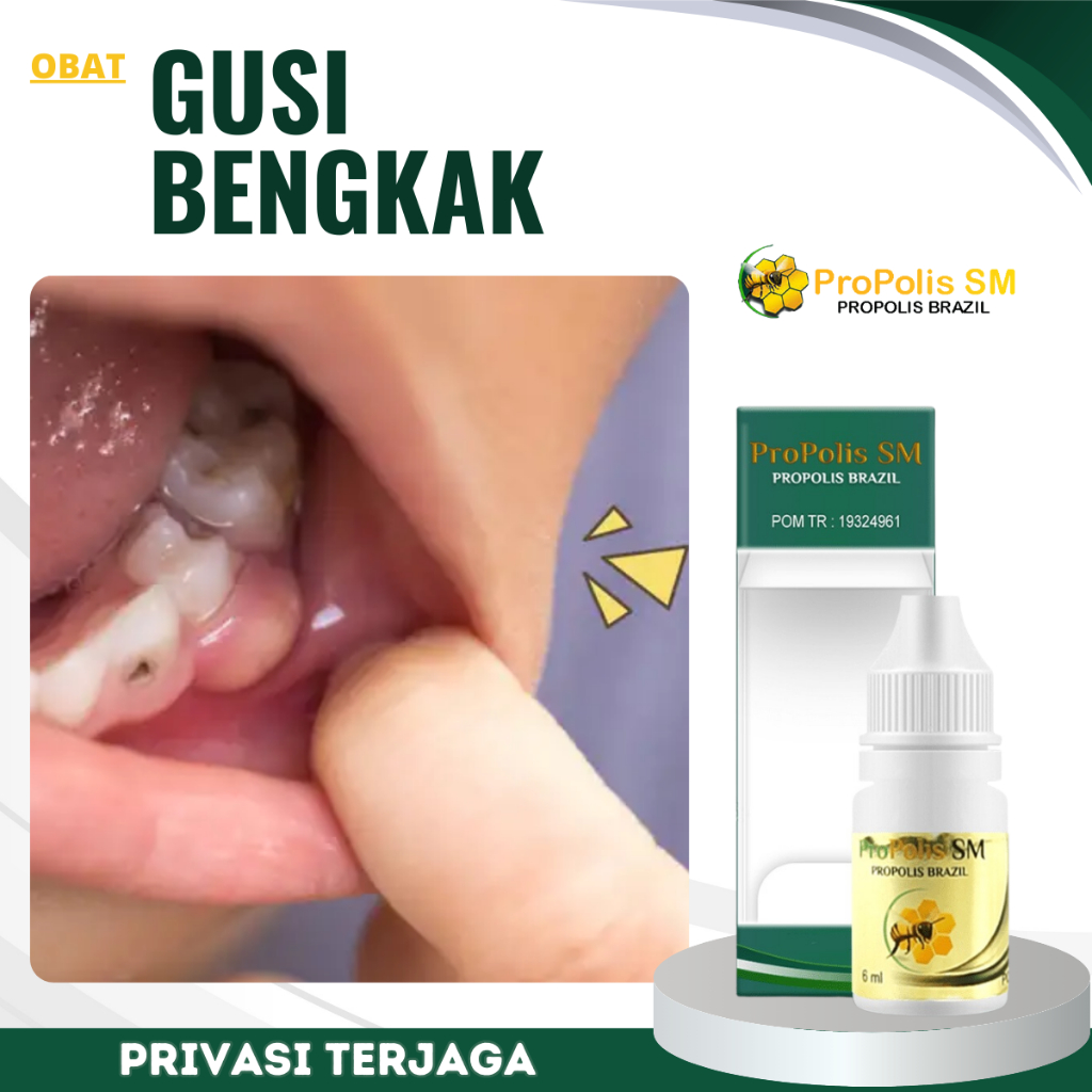 Obat Gusi Bengkak, Obat Radang Gusi, Obat Gusi Berdarah, Obat Gusi Ngilu, Obat Pengempis Gusi Bengka