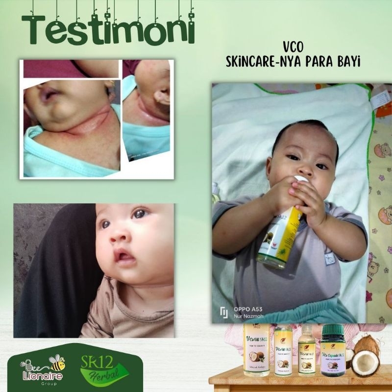 READY STOK BANDA ACEH MINYAK KELAPA VCO SR12 REKOM UNTUK ANAK BAYI ATASI ALERGI GATAL GATAL HALAL BP