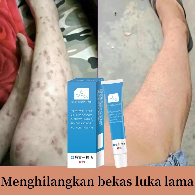 Scar Remover for Old Scar on Leg Stretch Mark Remover Acne Scar Remover Peklat Remover Cream Origina