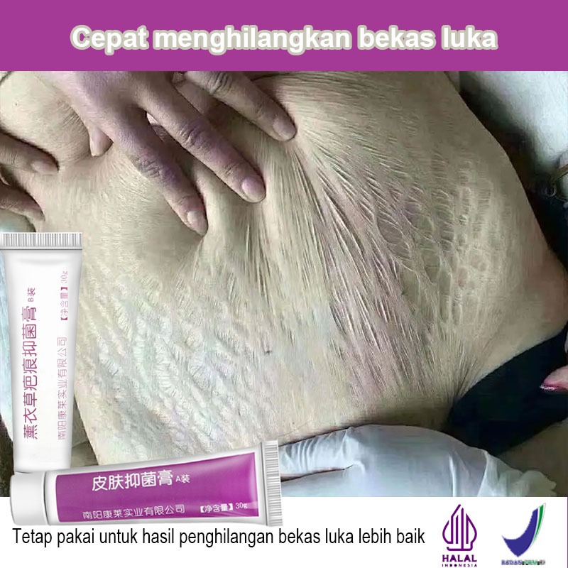 Memudar Stretch Mark penghilang bekas luka hitam koreng obat penghilang bekas koreng penghilang kore